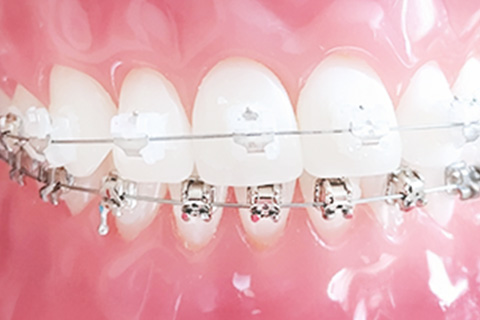 上前歯のみ審美矯正装置+メタルワイヤー